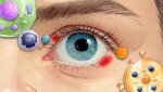 眼疮常复发？未必只是「眼挑针」