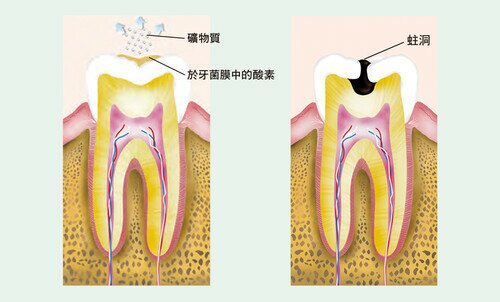  飲食後，牙菌膜的細菌會分解食物中的糖分，產生酸素，若吃喝次數頻密，經過一段時間後，牙齒會被慢慢侵蝕形成蛀洞。