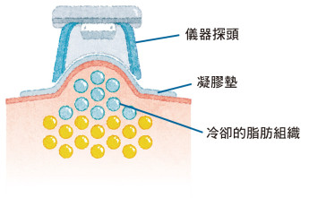 儀器探頭會吸住皮膚，將該範圍的皮下脂肪組織逐步冷卻。