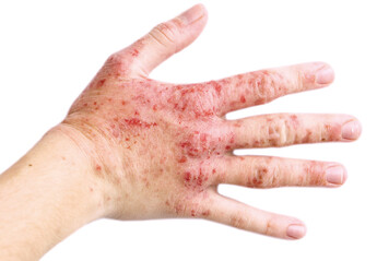 急性湿疹大多会引发剧烈痕痒，渗液也较多，皮肤常有水疱、丘疹、红斑、肿胀、糜烂等