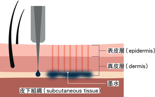 图一：在纹身的过程，纹身针会重复刺穿皮肤的表皮层（epidermis），让墨水穿过表皮进入真皮层（dermis）。