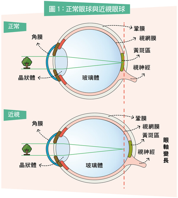 深近視（超過600度）人士，由於眼球被拉長，令視網膜變薄，因此，患有視網膜脫落的風險較一般人為高