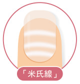 米氏線