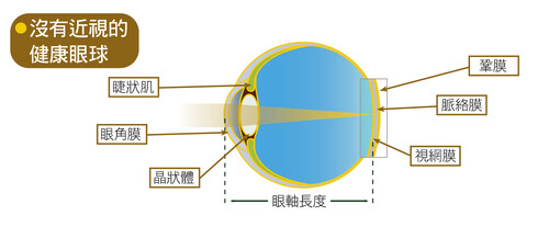 光线正确聚焦在视网膜上，形成清晰的影像。
