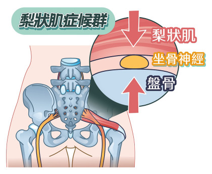 位于臀部深层的梨状肌因压迫坐骨神经,导致臀部、大腿后侧甚至小腿出现酸痛、麻木或放射性腿痛。