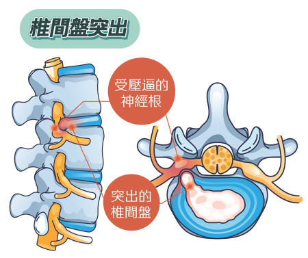坐骨神经痛的成因?