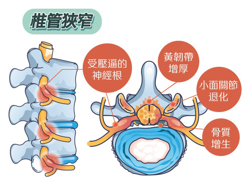 坐骨神经痛的成因?