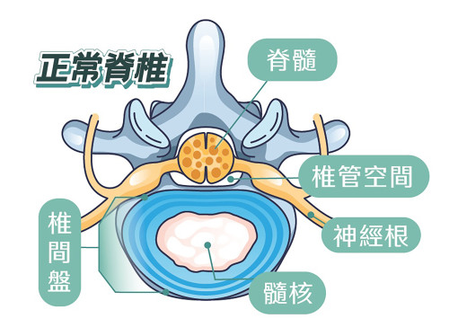 坐骨神经痛的成因?