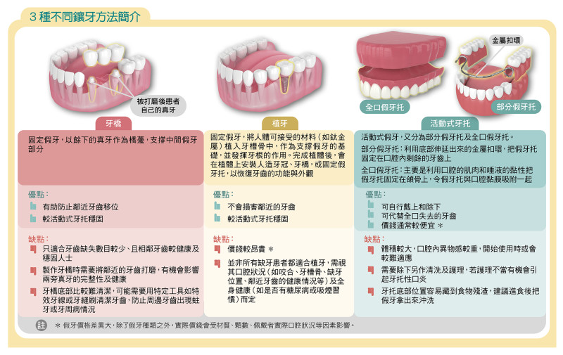 假牙的種類及簡介