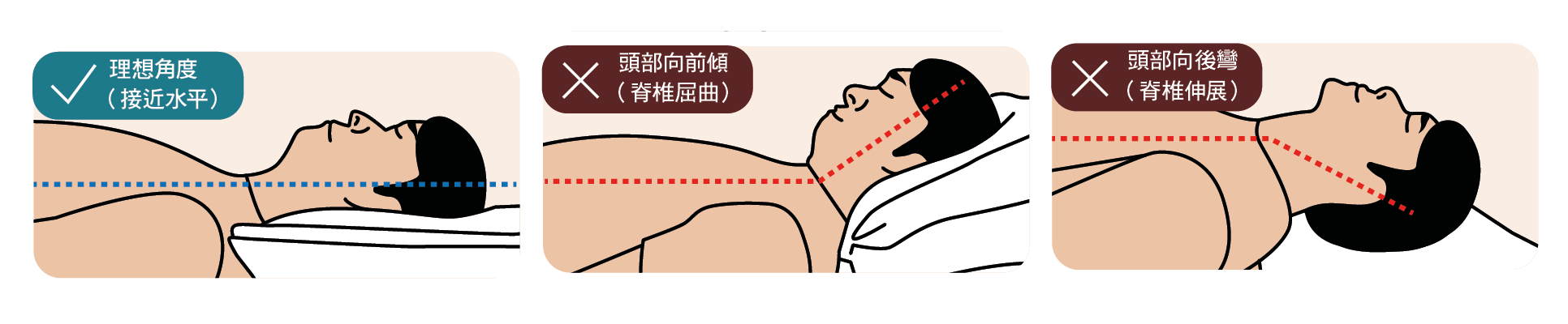 图3：仰卧时的头部角度