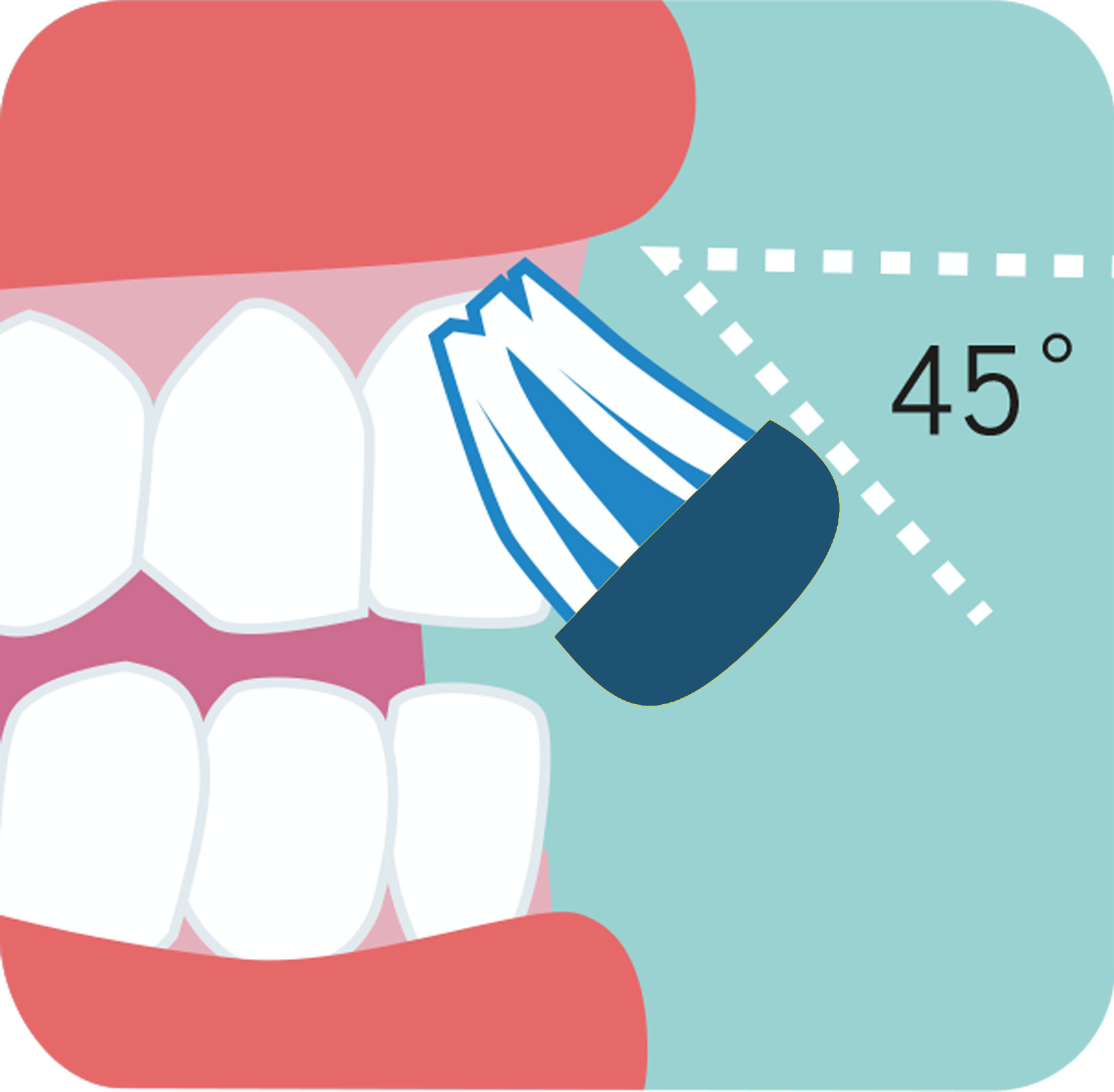 圖五：美國牙科協會建議刷牙時將牙刷以45度角貼近牙齦線。