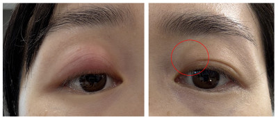 图中女士右眼先出现麦粒肿，痊愈不久后，左眼又出霰粒肿